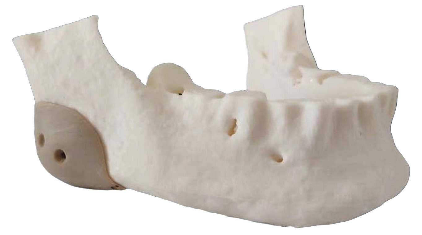 Implante de ángulo mandibular a la medida fijado sobre un modelo de mandíbula impreso en 3D